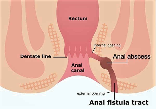 best-fistula-doctor-in-andheri